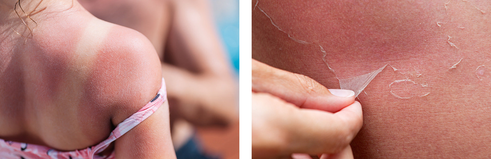 Sonnenbrand in unterschiedlichen Stadien